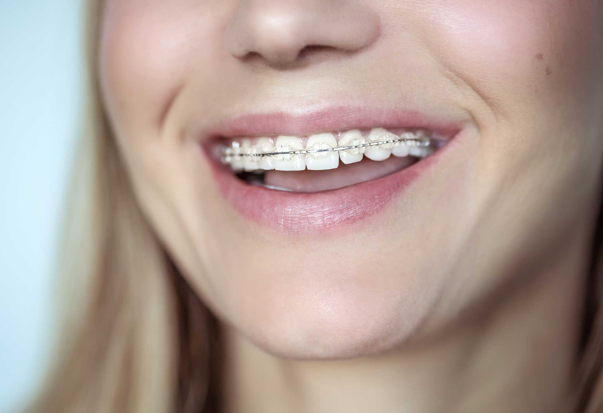 ortodoncia en Barcelona y Gavá, dentistas en Barcelona y Gavá, clínica dental en Barcelona y Gavá.