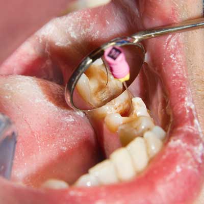 clínica dental en Barcelona y Gavá, dentista en Barcelona y Gavá, endodoncia en Barcelona y Gavá, centro odontológico de referencia en Barcelona y Gavá.