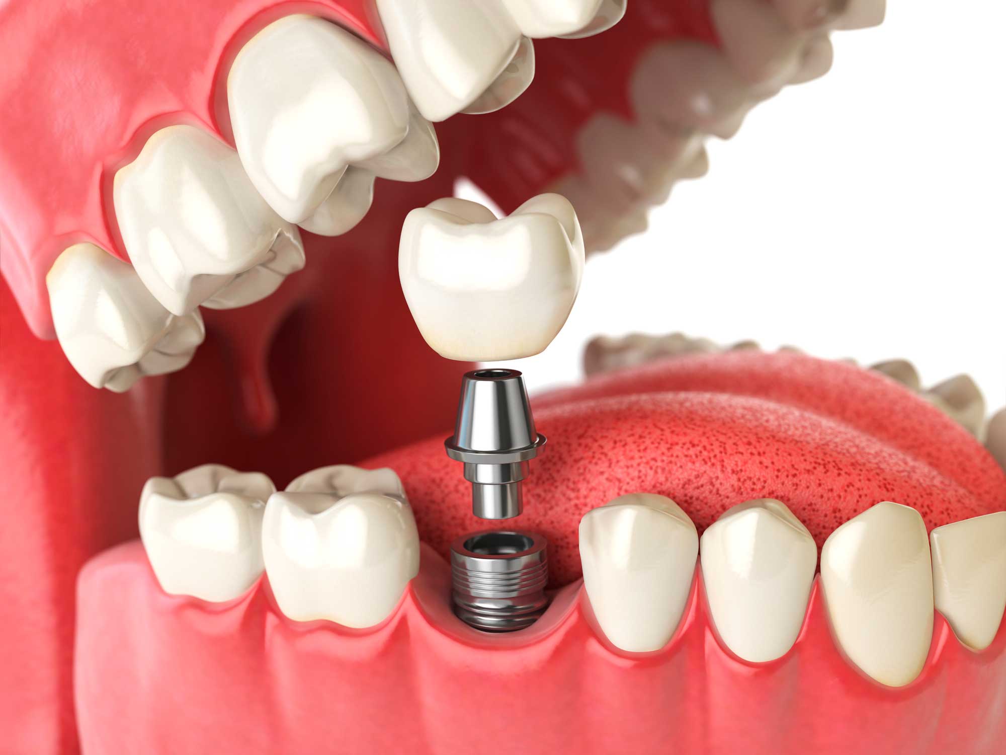 implantología oral en Barcelona y Gavá, dentista en Barcelona y Gavá, clínica dental en Barcelona y Gavá.