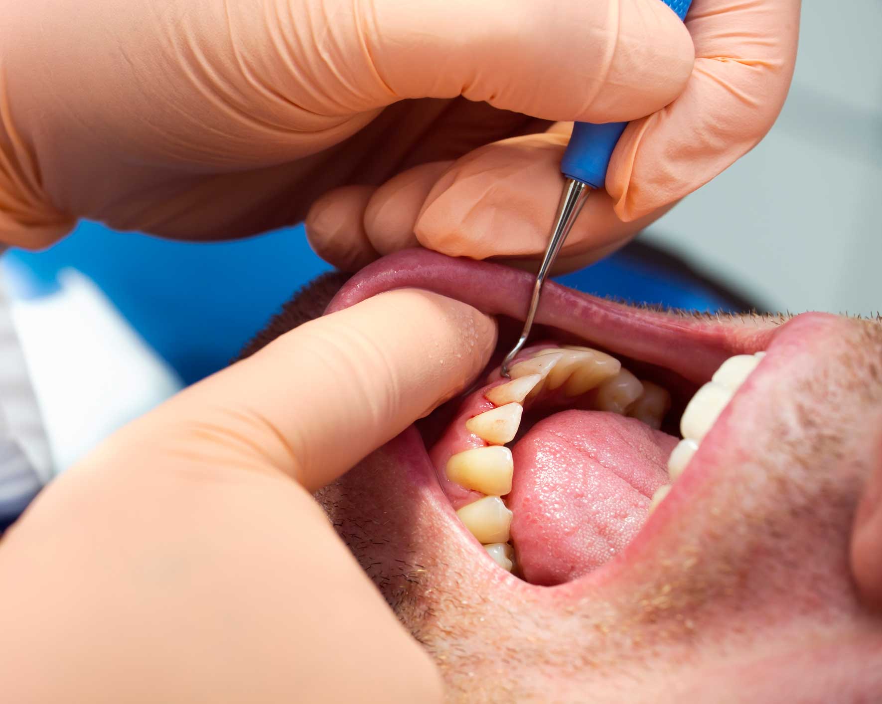 periodoncia en Barcelona y Gavá, dentista en Barcelona y Gavá, clínica dental en Barcelona y Gavá.