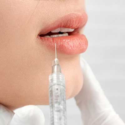 ácido hialurónico en Barcelona y Gavá, aumento de labios sin cirugía en Barcelona y Gavá, aumento de labios en Barcelona y Gavá.